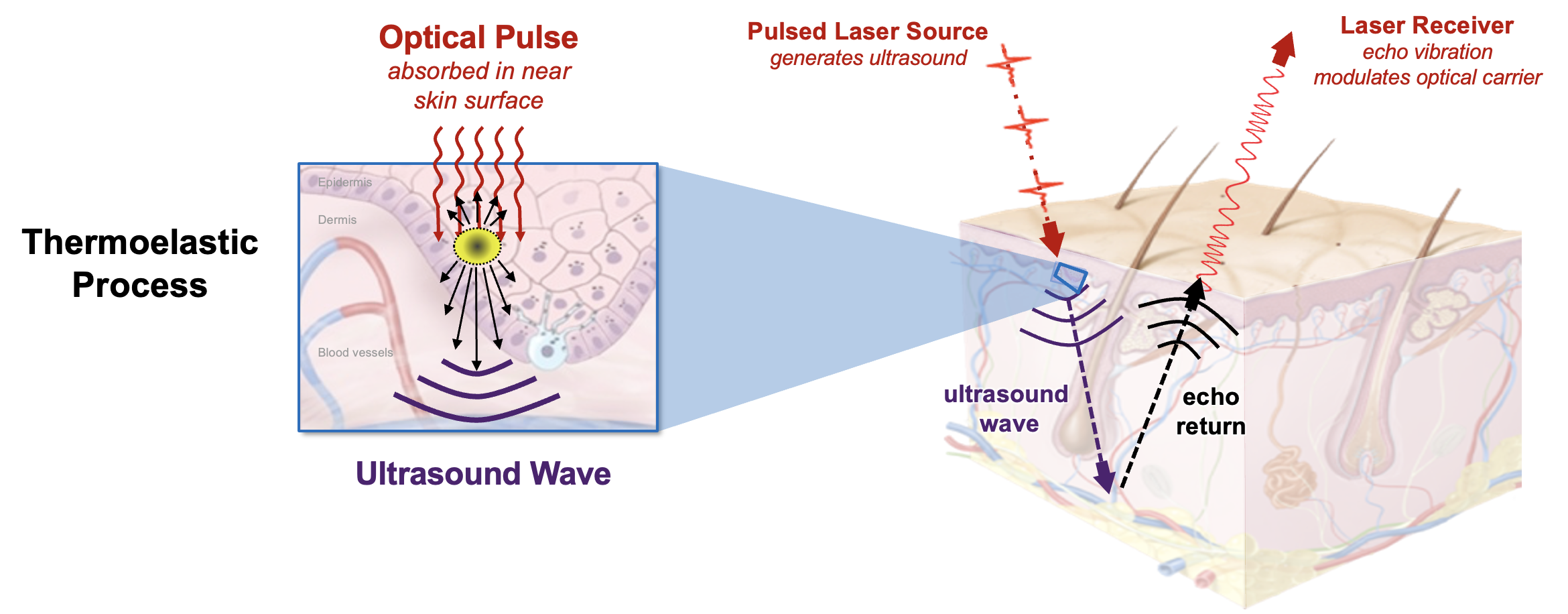 A schematic showing the thermoelastic process of optical energy absorbing near the skin surface, causing tissue to locally heat and deform and generating ultrasonic waves, which echo back to the surface.