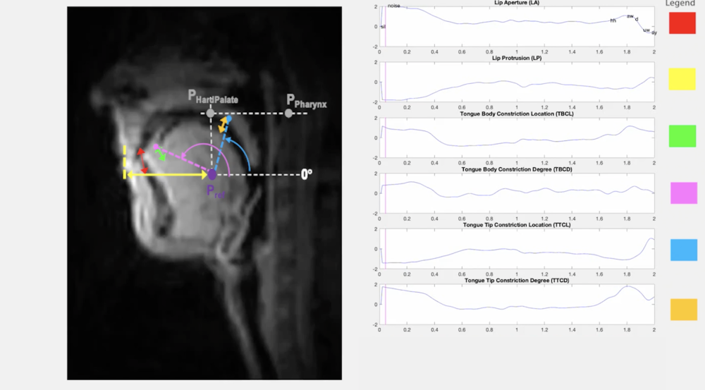 Real-time MRI imaging with articulatory trajectories may provide physiological insight into subtle changes in speech production under PTSD. (MRI video courtesy of University of Southern California.)