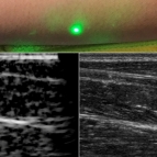 An ultrasound technique uses lasers to produce images beneath the skin without making contact. The new laser ultrasound technique was used to produce an image (left) of a human forearm (above), which was also imaged using conventional ultrasound (right).