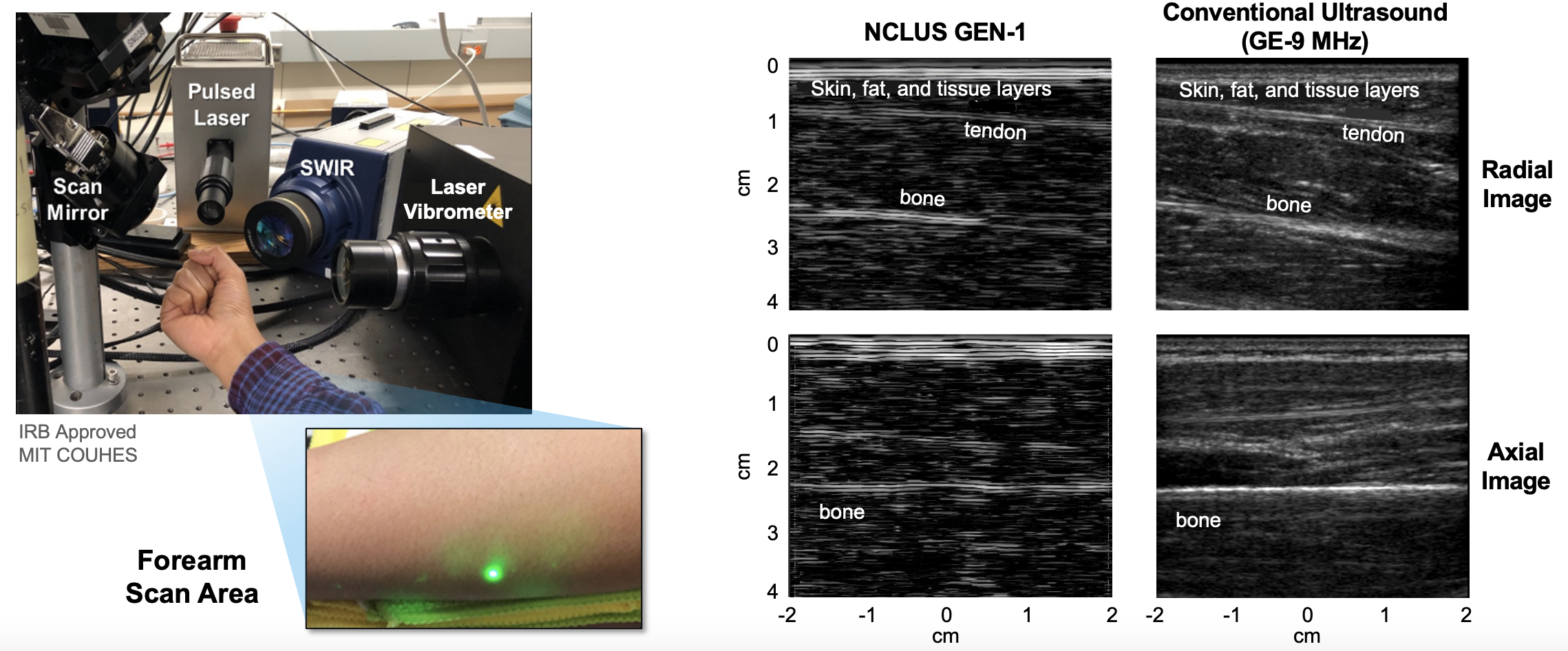 Three images show the Noncontact Laser Ultrasound first-generation system, a forearm scan area, and a comparison of system images to those of conventional ultrasound.