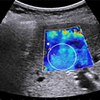 The example shear-wave elastograph of liver fibrosis staging shows the vibrant color-coded area enabled by SWE Assist.