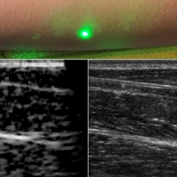 An ultrasound technique uses lasers to produce images beneath the skin without making contact. The new laser ultrasound technique was used to produce an image (left) of a human forearm (above), which was also imaged using conventional ultrasound (right).