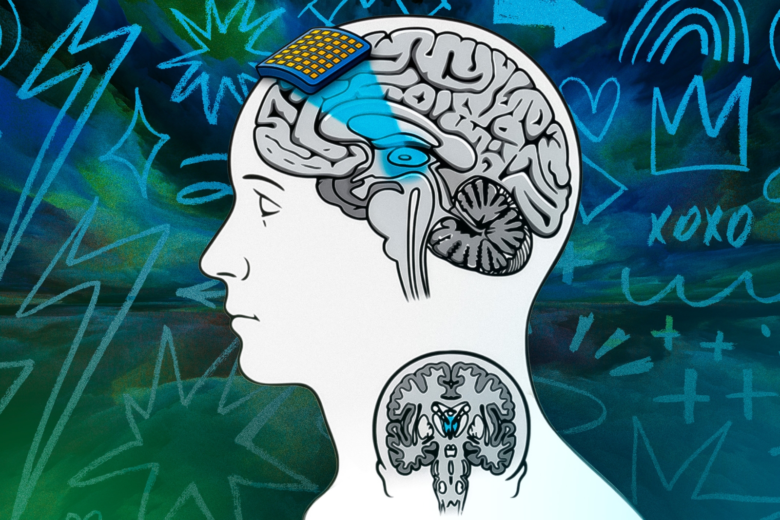 Transcranial focused ultrasound, a noninvasive brain imaging tool depicted in the illustration, may help researchers gain knowledge about human consciousness.