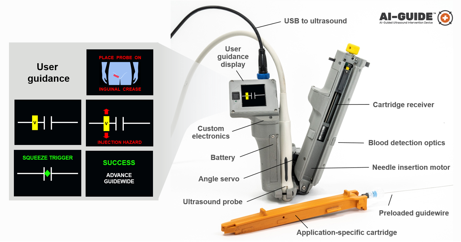 AI-GUIDE is a handheld ultrasound device with AI software and a guidance display that instructs the user on how to catheterize a blood vessel. 